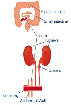 Urostomie