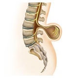 Myelomeningocelis