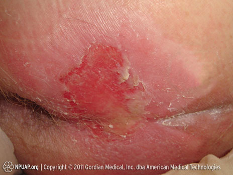 Escarre stade II : Perte de la peau d’épaisseur partielle ou cloque 