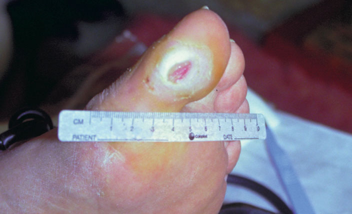Plaie  du pied diabétique d’origine neuropathique