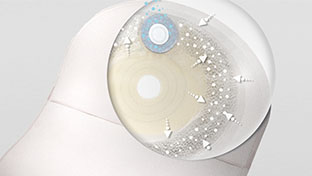 Darstellung des einzigartigen ringförmigen Vorfilters der SenSura Mio-Beutel