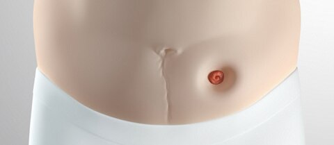 Ist Ihr Stoma Profil nach innen gewölbt?